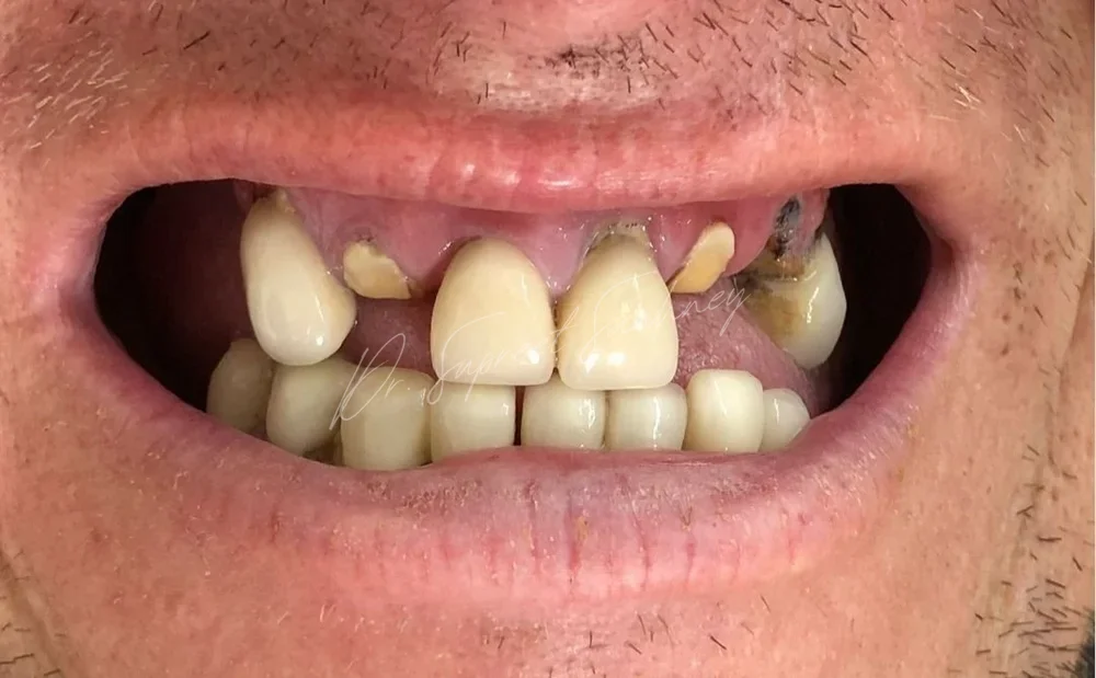 Close-up smile photograph before anterior aesthetic rehabilitation, showing missing and fractured maxillary anterior teeth